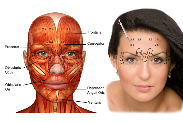 Illustration of cosmetic uses of Botulinum with embedded text